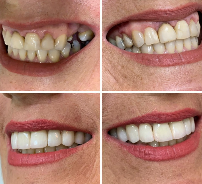Comparativo antes e depois de paciente reabilitada com prótese sobre implantes na unidade São Carlos.