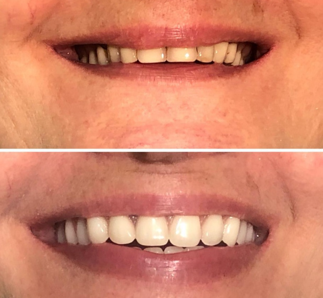 Comparativo antes e depois de paciente com sorriso reconstruído por prótese fixa.